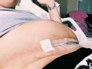 Bà bầu - Bà mẹ đăng ảnh vết đẻ mổ tươi khẳng định: "Sinh mổ không hề nhẹ nhàng"