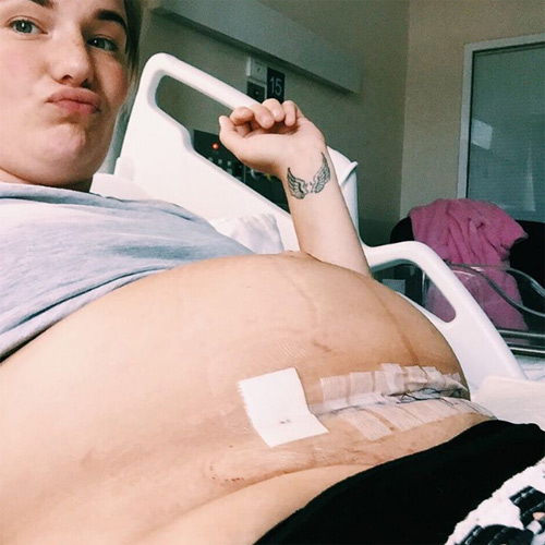 Bà mẹ đăng ảnh vết đẻ mổ tươi khẳng định: amp;#34;Sinh mổ không hề nhẹ nhàngamp;#34; - 1