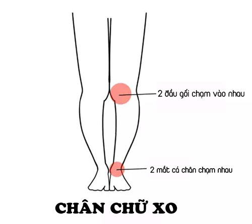 Mẹo chọn đồ khắc phục dáng chân chữ bát, chân vòng kiềng - 13