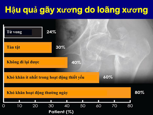 Loãng xương – phòng bệnh ngay trước khi quá muộn! - 2
