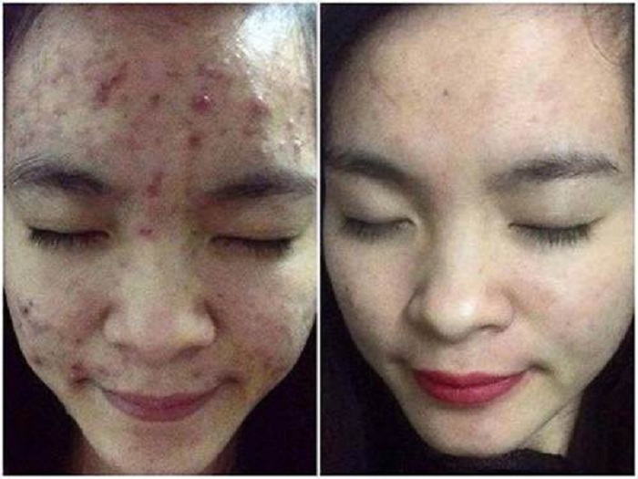 Vừa tắm trắng, lại se khít lỗ chân lông hiệu quả chỉ với lon bia 10 ngàn đồng - 4