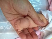Làm mẹ - Tay chân bé có ngấn tưởng bụ bẫm, hóa ra bệnh lạ