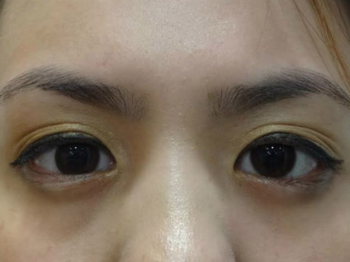 Ca mổ mắt của bác sĩ Việt giúp cô gái Mỹ thoát nguy cơ mù - 2