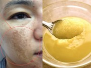 Làm đẹp - Trứng gà tươi và 2 cách xóa mờ tàn nhang, làm trắng da hiệu quả