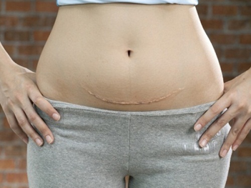 Đẻ mổ sẽ được sinh con tối đa bao nhiêu lần? - 2