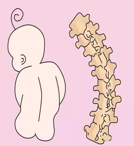 Con trai bị cong vẹo cột sống khi mới 4 tuổi, mẹ tá hỏa khi phát hiện ra nguyên nhân - 2