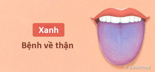 Màu lưỡi nói lên tình trạng sức khỏe của bạn thế nào? - 4