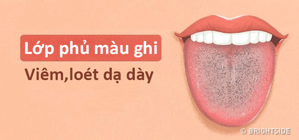 Màu lưỡi nói lên tình trạng sức khỏe của bạn thế nào? - 11