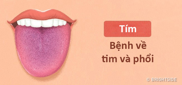 Màu lưỡi nói lên tình trạng sức khỏe của bạn thế nào? - 6