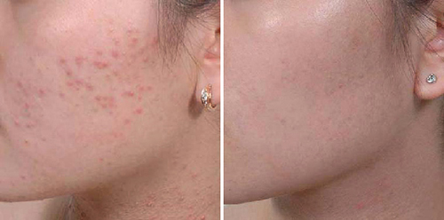 Cách chữa mụn ẩn, mụn li ti hiệu quả với amp;#34;bài thuốcamp;#34; tiết kiệm - 7