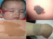 Làm mẹ - Bí mật về các loại bớt thường gặp ở trẻ sơ sinh và sự nguy hại đến sức khỏe của bé