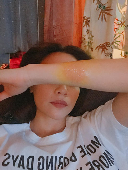 Bị bỏng rộp ở tay, Hồ Ngọc Hà cầu cứu cư dân mạng - 1