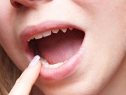 Sức khỏe - Ngoài âm đạo, các vùng này trên cơ thể cũng rất dễ bị nhiễm nấm men