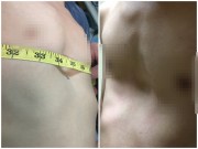 Làm mẹ - Bác sĩ chỉ cách phát hiện và điều trị bệnh lõm ngực bẩm sinh ở trẻ