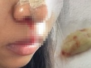 Tin tức - Khó thở sau khi đi nâng mũi, cô gái trẻ giật mình vì bác sĩ quên lấy băng gạc sau phẫu thuật