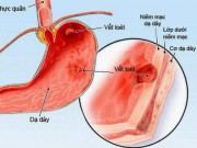 Sức khỏe - Tưởng con bị giun hoá ra viêm loét dạ dày vì lây vi khuẩn HP từ mẹ