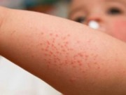 Sức khỏe - Sốt xuất huyết: Những dấu hiệu bệnh chuyển nặng, nguy hiểm