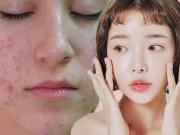 Làm đẹp - Bỏ túi ngay 2 cách trị mụn trứng cá tại nhà bằng lòng trắng trứng gà và nha đam!