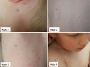 Làm mẹ - Hình ảnh bệnh thủy đậu ở trẻ em, cha mẹ cần biết để điều trị hiệu quả