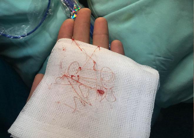 Dân mạng xôn xao trước ca amp;#34;thảm họaamp;#34; thủng da đầu mũi, lộ chỉ trắng ngay khi phẫu thuật - 2