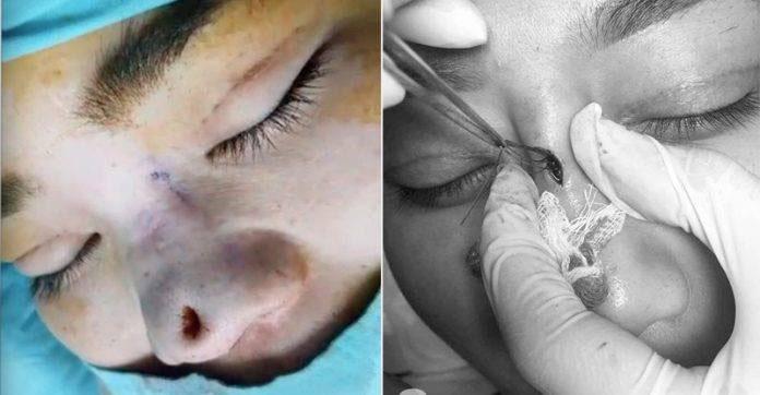 Dân mạng xôn xao trước ca amp;#34;thảm họaamp;#34; thủng da đầu mũi, lộ chỉ trắng ngay khi phẫu thuật - 5