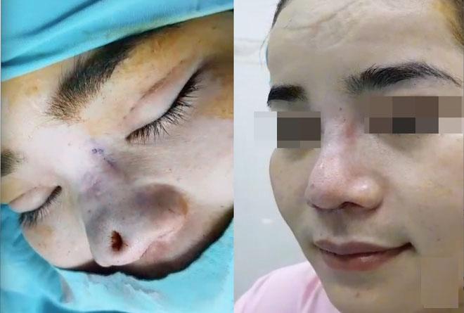 Dân mạng xôn xao trước ca amp;#34;thảm họaamp;#34; thủng da đầu mũi, lộ chỉ trắng ngay khi phẫu thuật - 3