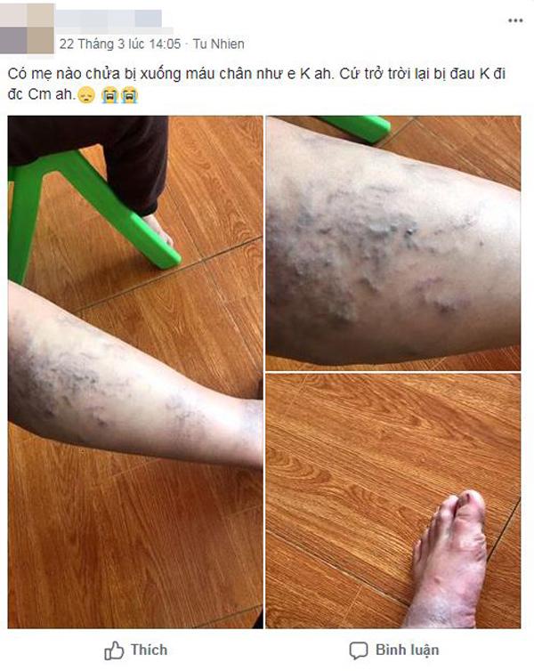Mẹ bầu đăng ảnh tưởng chân xuống máu, bác sĩ nói amp;#34;đi khám ngay kẻo nguyamp;#34; - 1