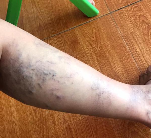 Mẹ bầu đăng ảnh tưởng chân xuống máu, bác sĩ nói amp;#34;đi khám ngay kẻo nguyamp;#34; - 2