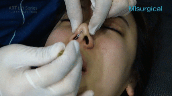 Dân mạng xôn xao trước ca amp;#34;thảm họaamp;#34; thủng da đầu mũi, lộ chỉ trắng ngay khi phẫu thuật - 7