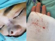 Đẹp - Dân mạng xôn xao trước ca "thảm họa" thủng da đầu mũi, lộ chỉ trắng ngay khi phẫu thuật