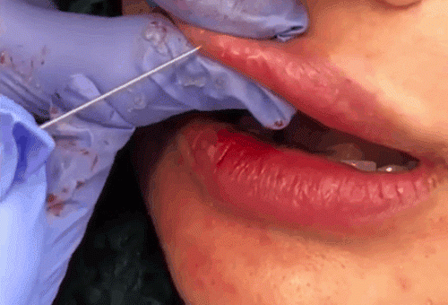 Xem những hình ảnh này, còn ai dám ham rẻ mà tiêm filler kém chất lượng nữa không? - 7