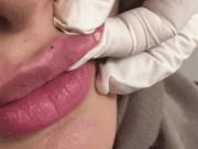 Đẹp - Xem những hình ảnh này, còn ai dám ham rẻ mà tiêm filler kém chất lượng nữa không?