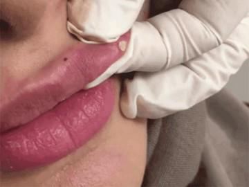 Xem những hình ảnh này, còn ai dám ham rẻ mà tiêm filler kém chất lượng nữa không?