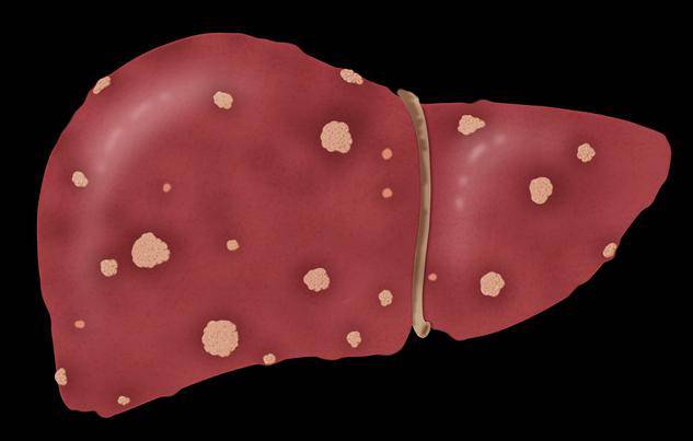 Cô gái nhập viện bụng to như chửa vì thói quen tai hại, bác sĩ kết luận amp;#34;đã quá muộnamp;#34; - 5