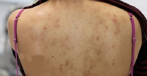 Dù lưng có nhiều mụn và vết thâm đến mấy cũng sạch bách với những cách này - 1