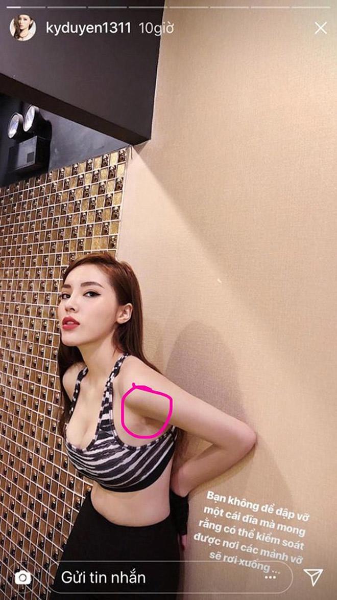Im lặng hay phủ nhận amp;#34;dao kéoamp;#34;, thì vết sẹo kì lạ này cũng đã lên tiếng thay chủ nhân! - 6