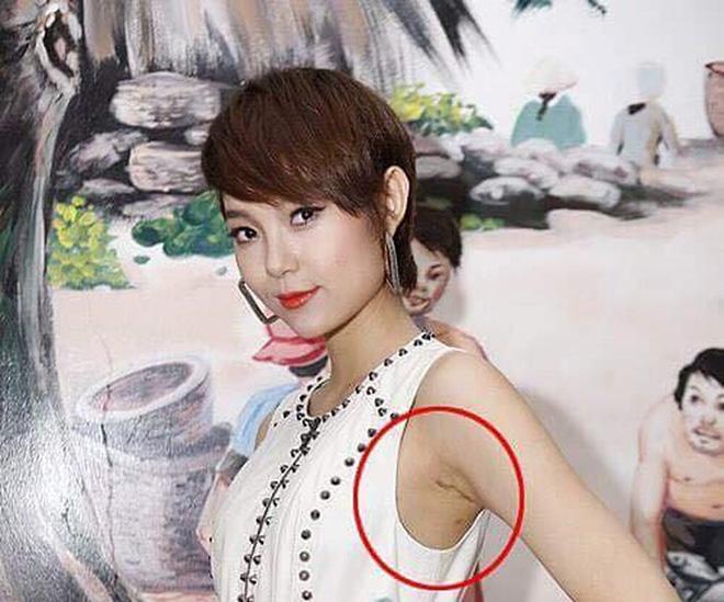 Im lặng hay phủ nhận amp;#34;dao kéoamp;#34;, thì vết sẹo kì lạ này cũng đã lên tiếng thay chủ nhân! - 8