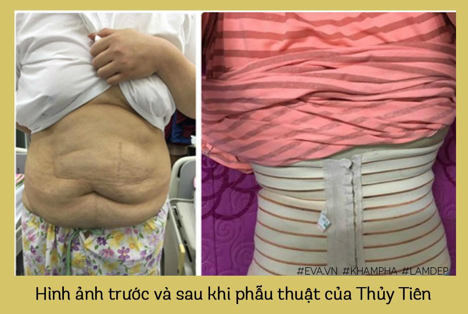 Để lột xác như Đức Phúc, amp;#34;Hot girl trăm kýamp;#34; Thuỷ Tiên lên bàn mổ cắt 8 lít mỡ! - 3