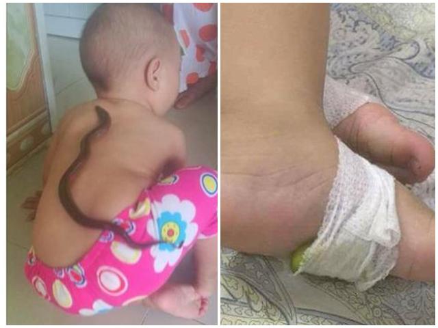 Hạ sốt cho trẻ bằng lươn sống, buộc chanh vào chân: Mẹ bỉm sữa tin dùng, bác sĩ nói Đừng!
