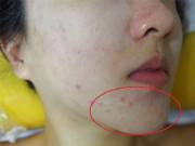 Làm đẹp - 2 cách trị mụn ẩn dưới da thuần thiên nhiên, không biết phí cả đời!