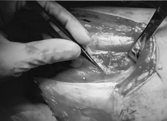 Thanh niên bị cắt “của quý” vì đắp thuốc nam “vùng kín” - 1