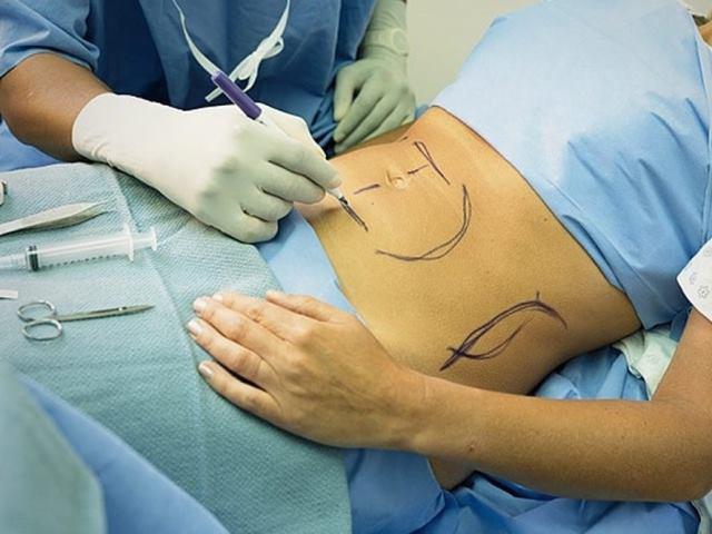 Kinh hoàng trước biến chứng nguy hiểm mà chị em có thể gặp phải khi hút mỡ bụng