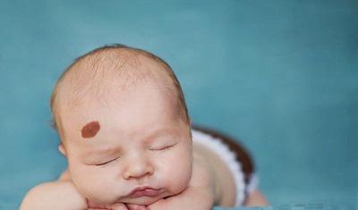 13 vấn đề về da thường gặp ở trẻ sơ sinh làm mẹ phải biết rõ - 4