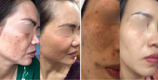 Lala Beauty Spa - địa chỉ amp;#34;vàngamp;#34; trị nám, tàn nhang cho phái đẹp - 2