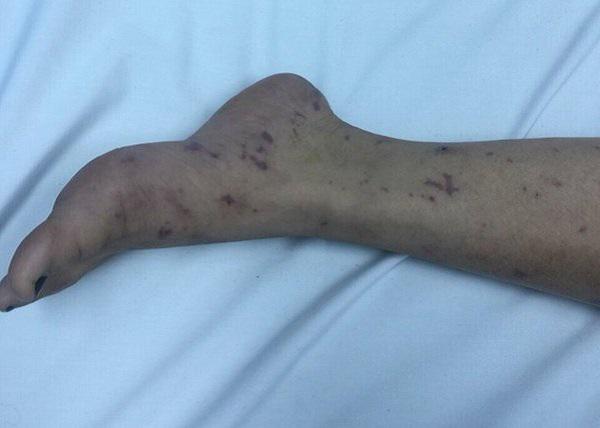 Hà Nội: Bị vi khuẩn “ăn não” tấn công, thiếu nữ 15 tuổi rơi vào trạng thái hôn mê - 1