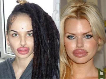 Chạy đua theo mốt bơm môi căng mọng và cái kết thảm họa đến giật cả mình