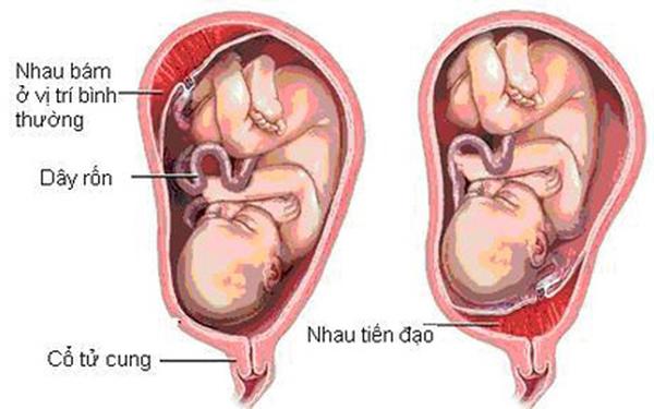 Ngoài ung thư nhau thai, còn có 5 bất thường về nhau thai mà phụ nữ nào cũng phải biết - 1