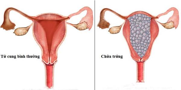 Nguyên nhân ít ai ngờ của bệnh ung thư nhau thai nguy hiểm mà không nhiều người hiểu rõ - 2