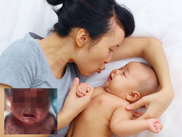 Bé sơ sinh 3 tháng tuổi lở loét khắp người vì được mẹ... hôn mỗi ngày