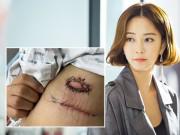 Giải trí - Sau ca phẫu thuật khối u mỡ, "Chị Đại" Han Ye Seul bức xúc vì vết thương bị lở loét